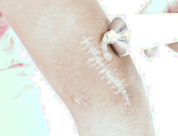 زخم های گسترده