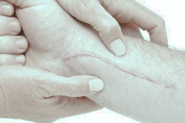 جای زخم کلوئید