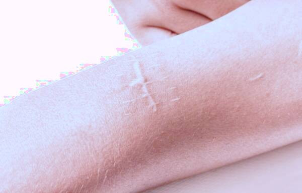 جای زخم و بخیه