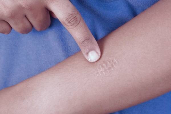 انواع جای زخم