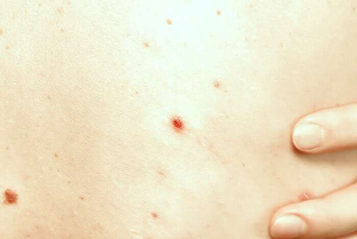 علل جوش زدن کمر