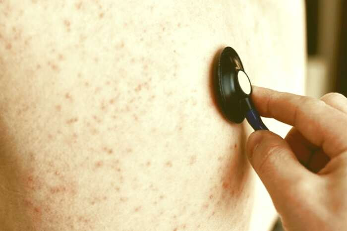 راه های درمان جوش کمر