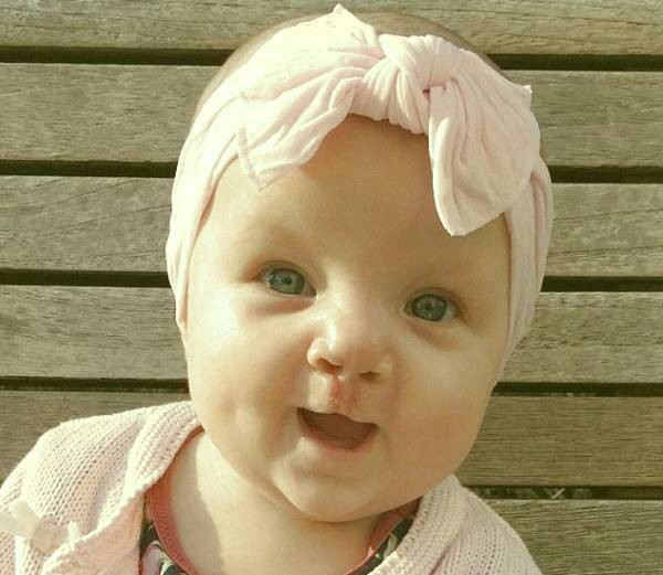 لب شکری کودکان