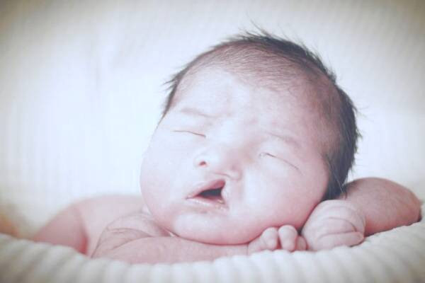 لب شکری شدن نوزاد