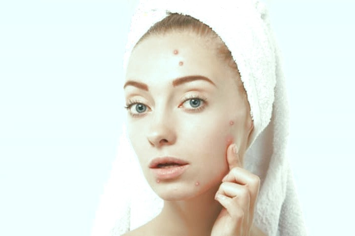 روش درمان آکنه 