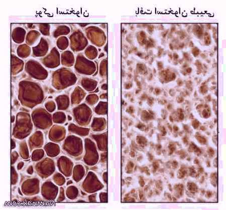 درمان پوکی استخوان