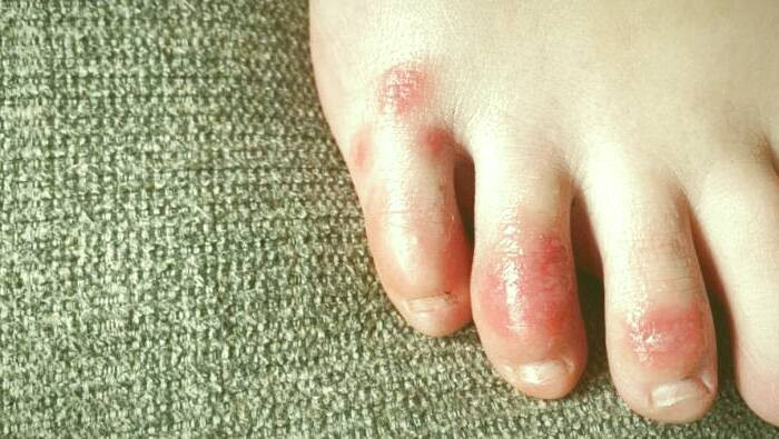 مشکلات پوستی کرونا