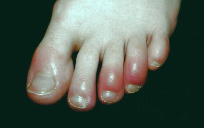 انگشت پای کوویدی