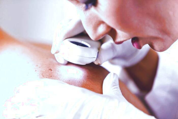 لکه های نوروفیبروماتوز