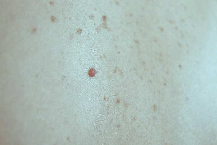 خال های سرطانی