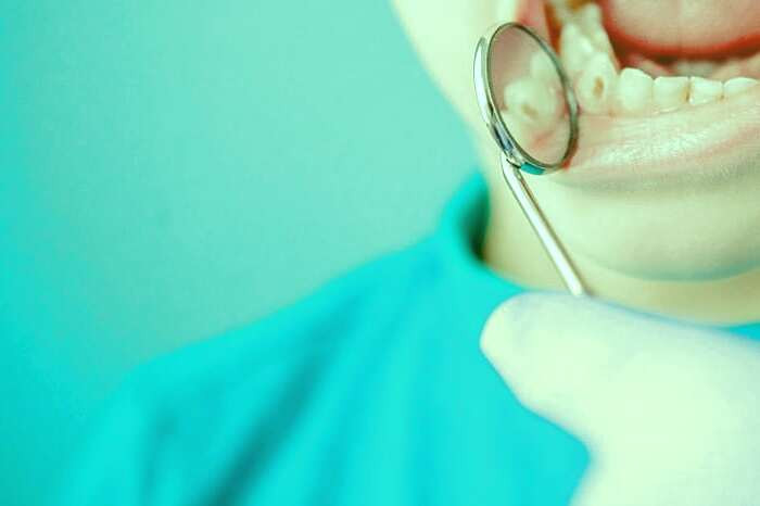 پوسیدگی دندانها