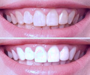 روش‌های موثر برای سفید کردن دندان‌ها