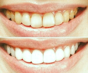 راهنمایی های آسان برای داشتن دندان های سفید و سالم