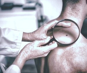رنگ خال و ارتباط آن با سرطان چیست؟