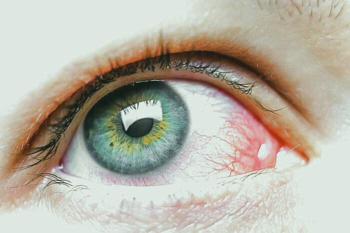 قرمزی چشم ها