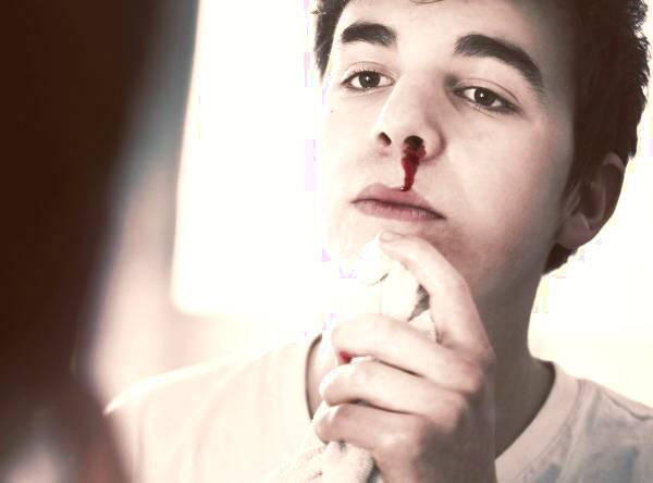 خونریزی از بینی