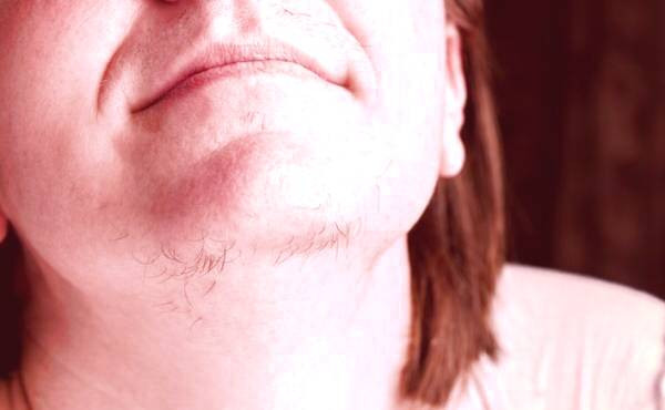 رشد غیر طبیعی مو زائد