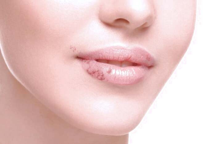 تبخال دهانی ایدز