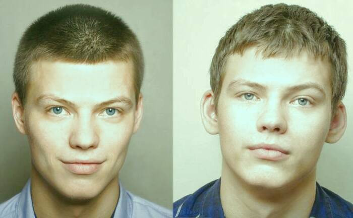 عمل اوتوپلاستی