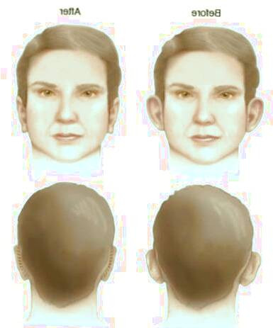 عکس اوتوپلاستی