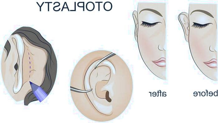 قبل عمل اوتوپلاستی