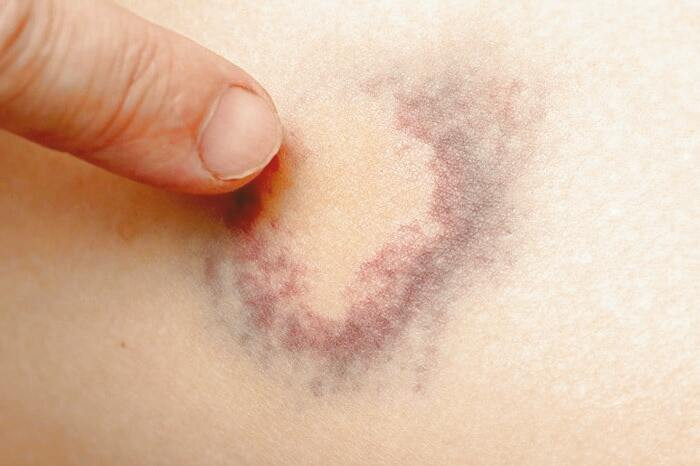 درمان زخم تازه