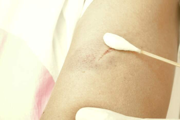 بهبود زخم سطحی