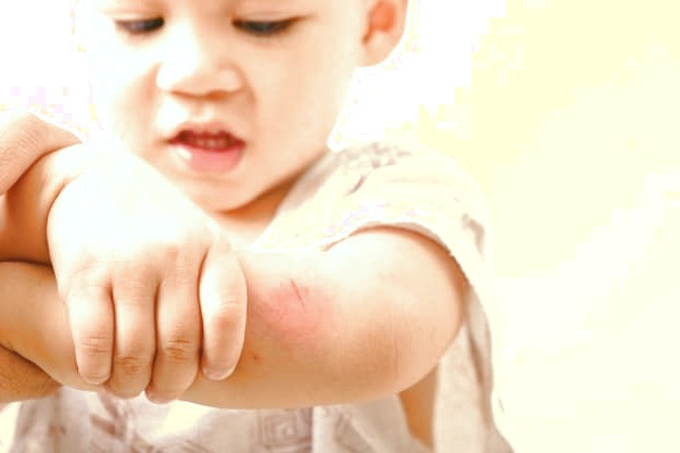 درمان زخم سطحی