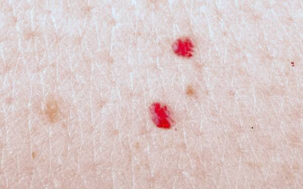 دلیل خال قرمز