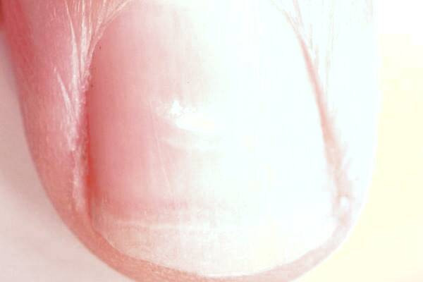 خونریزی ناخن