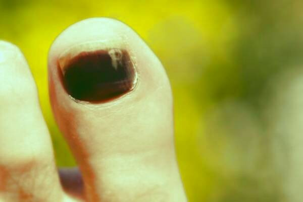 سیاه شدن ناخن