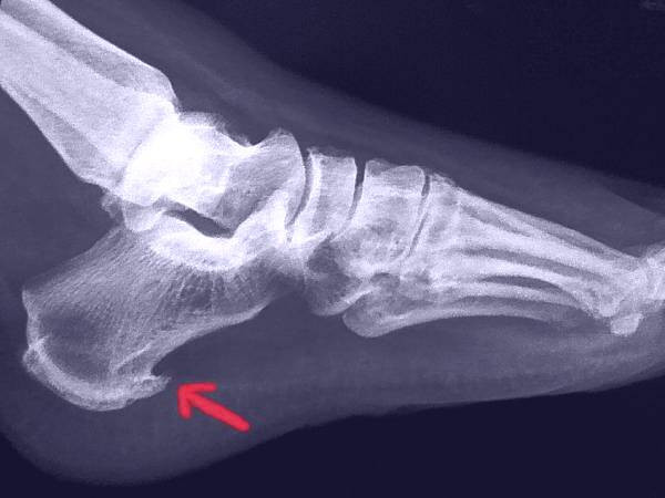 خار استخوانی پاشنه پا