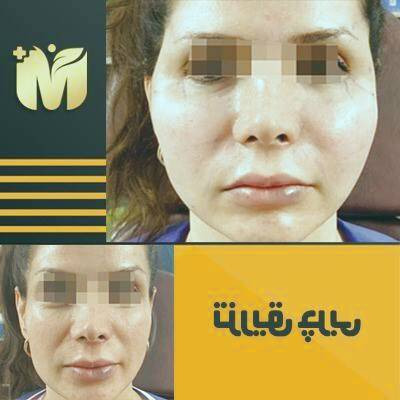 بررسی جامع تزریق چربی به صورت