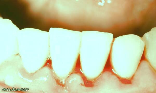 خونریزی لثه و علت آن