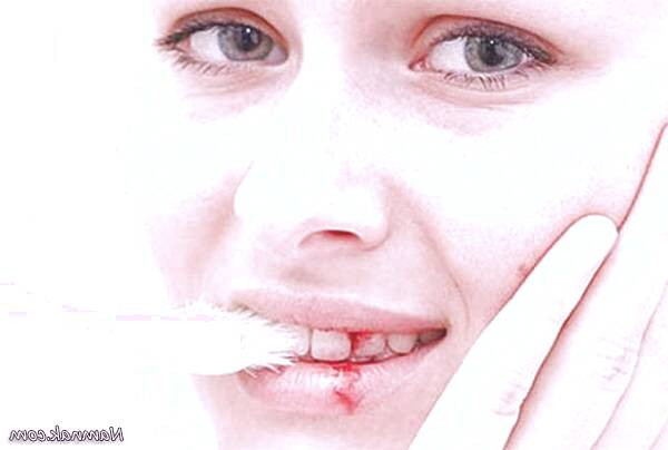 دلایل خونریزی لثه