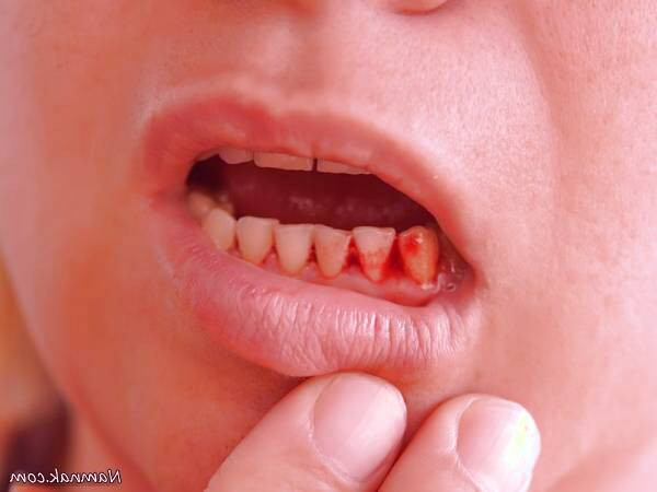 دلایل شایع خونریزی لثه 