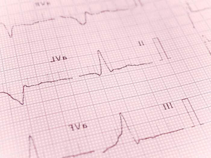 ضربان قلب نامنظم فیبریلاسیون دهلیزی