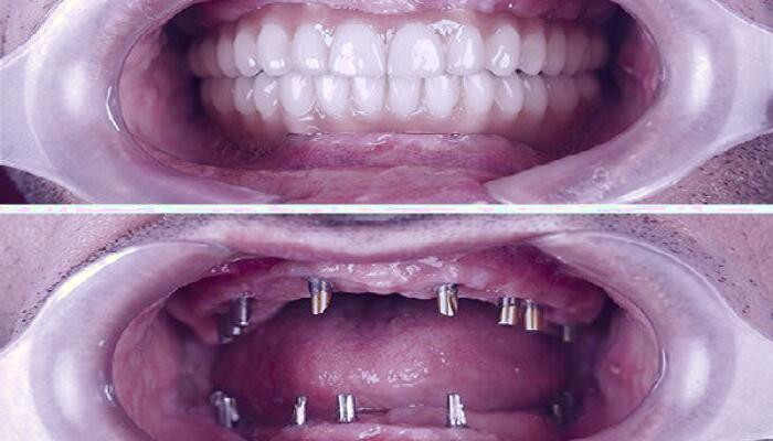 دندان‌های مصنوعی: گزینه‌ای مناسب برای همه؟