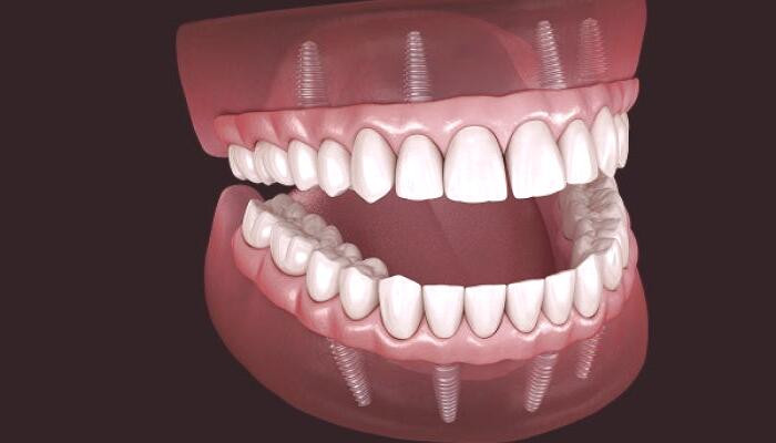 دندان‌های مصنوعی: گزینه‌ای مناسب برای همه؟