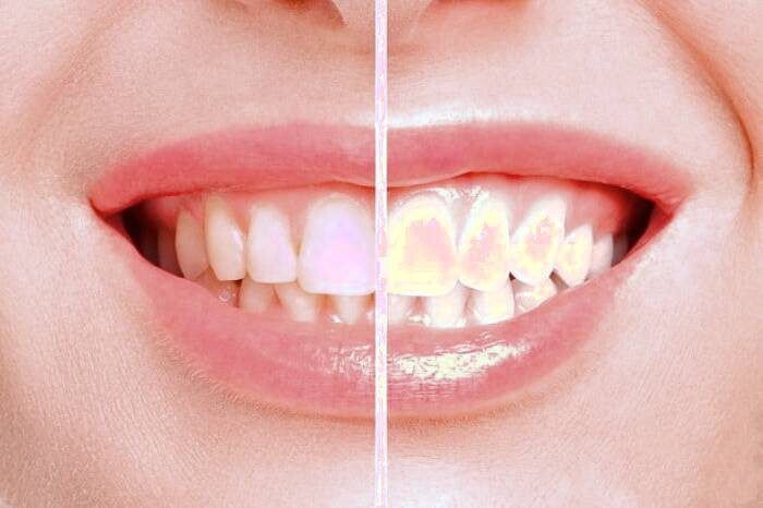 سفیدی دندان