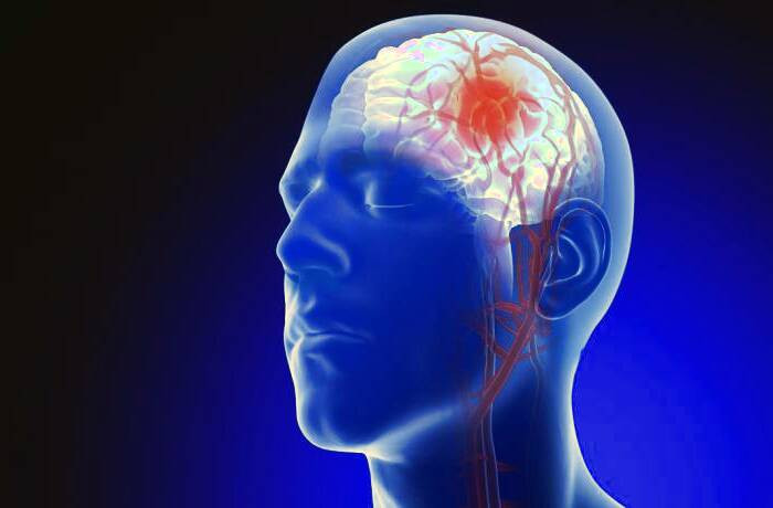 دلیل آنوریسم مغزی