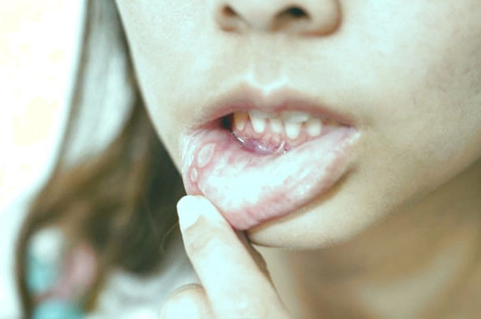 درمان آفت دهان