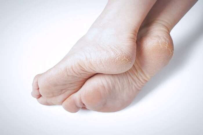 ترک پاشنه پا