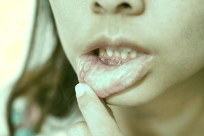 آفت دهان نشانه چیست