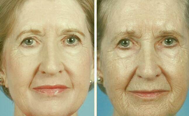 لیزر فرکشنال 