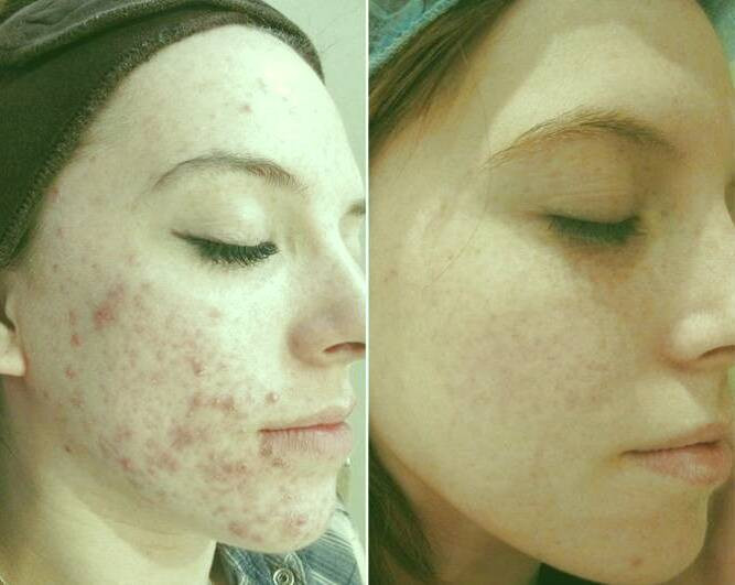 لیزر فرکشنال 