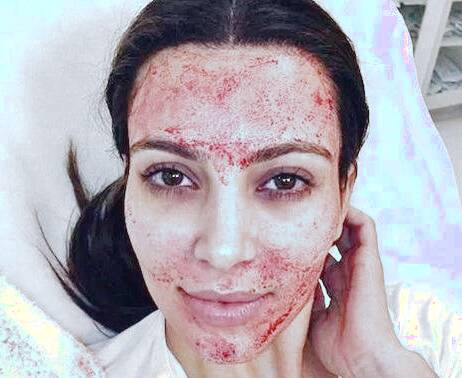 لیزر فرکشنال 