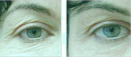 لیزر فرکشنال 