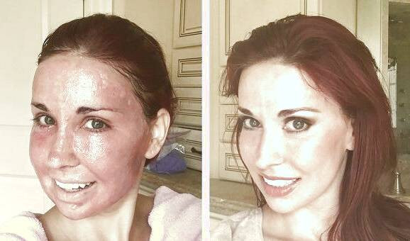 لیزر فرکشنال 