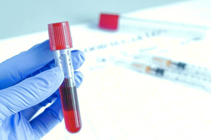  بیماری هموکروماتوز